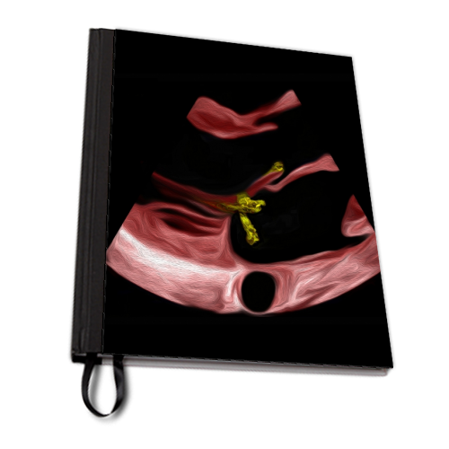 Heart - Infective Endocarditis - personalised A4, A5, A6 notebook by Echo Art
