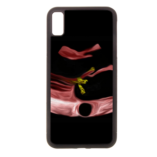 Heart - Infective Endocarditis - stylish phone case by Echo Art